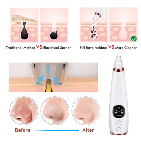 Electric Blackhead Remover